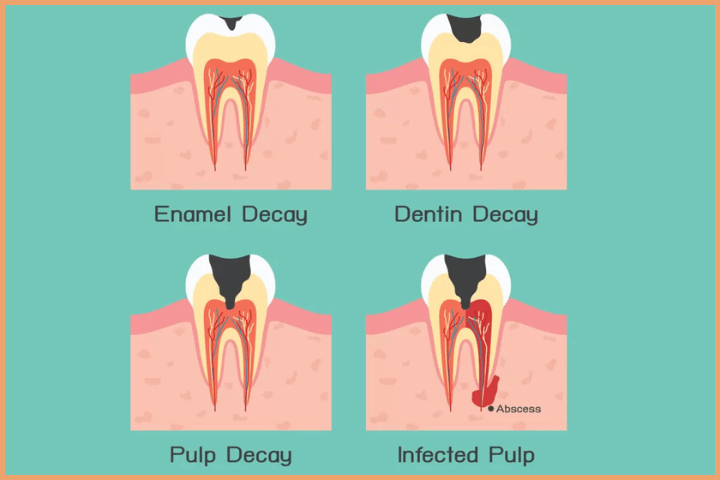 Importance of brushing teeth is to prevent decay