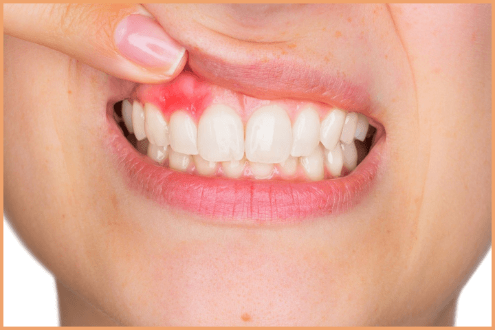 Importance of Brushing Teeth - Take care of your gums